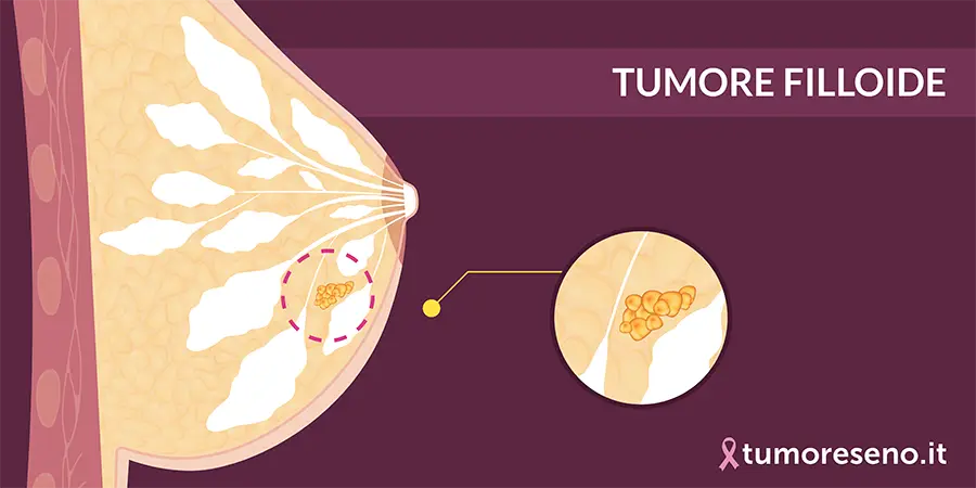 tumore filloide