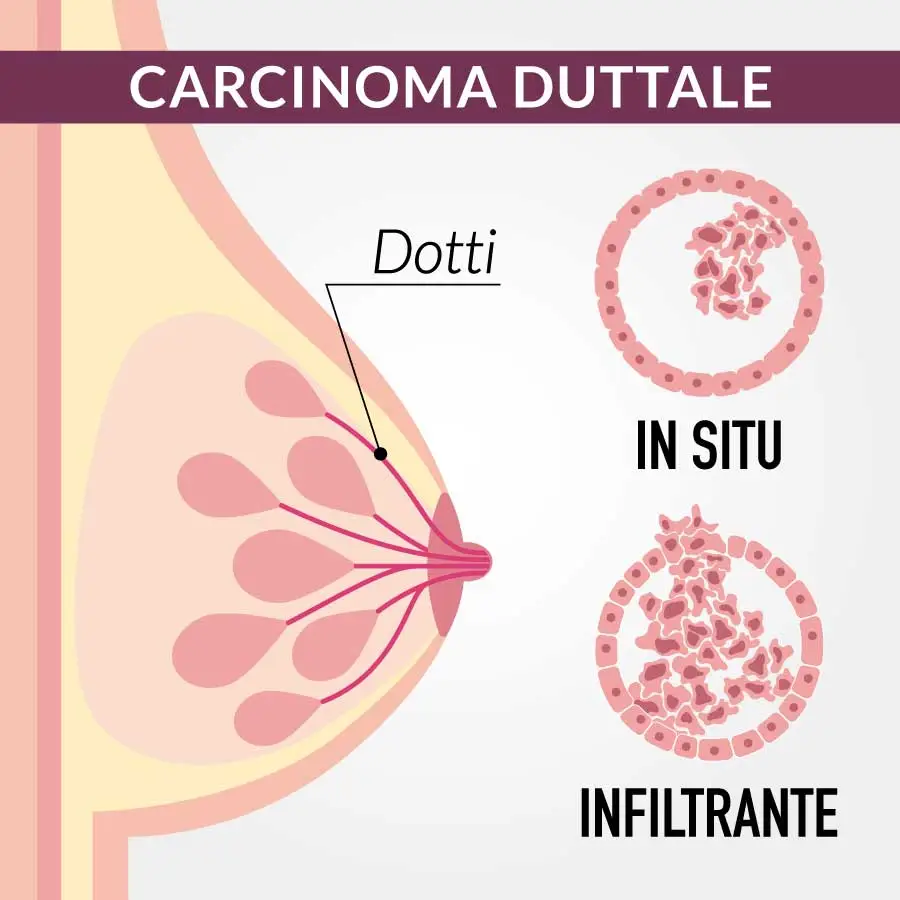 tumori al seno carcinoma duttale