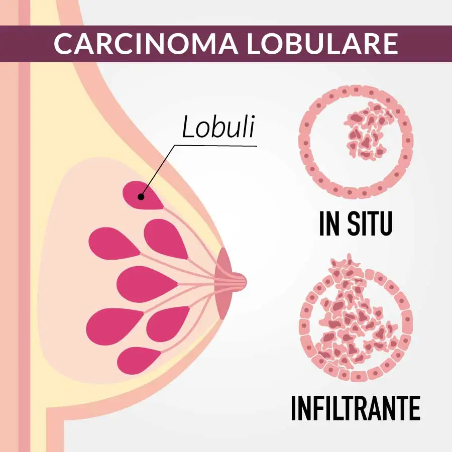 tumori al seno carcinoma lobulare